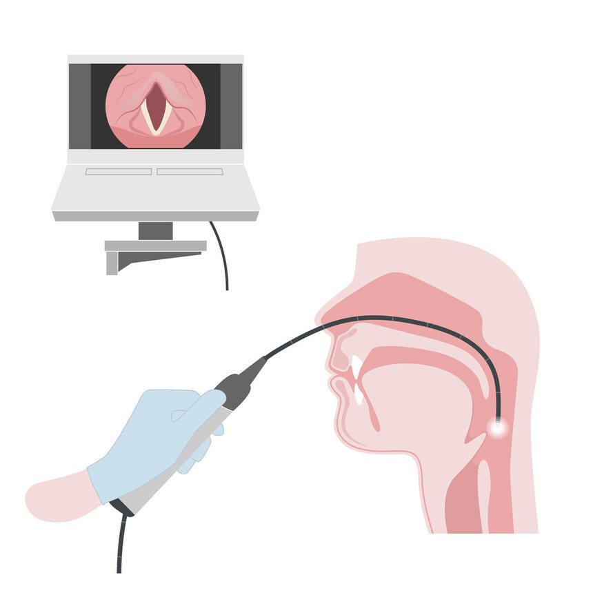 Schematische Darstellung einer FEES-Untersuchung mit endoskopischer Schluckdiagnostik über die Nase.